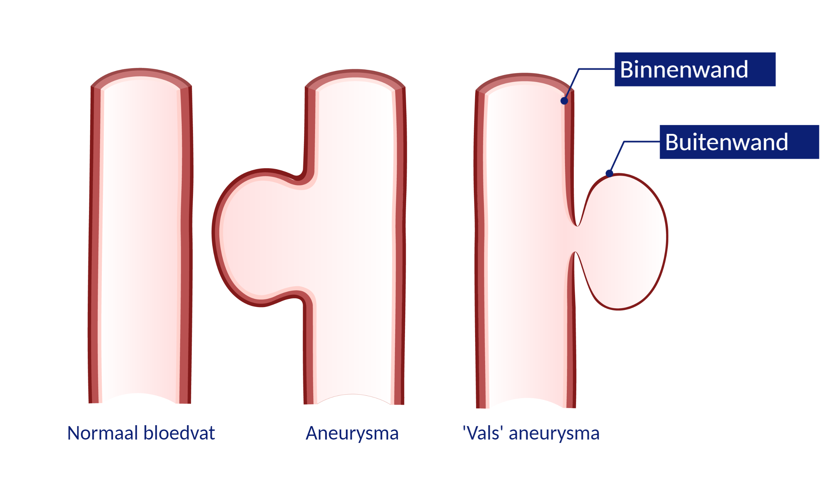 Lokaal injecteren medicatie - Patiëntenfolder - Erasmus MC